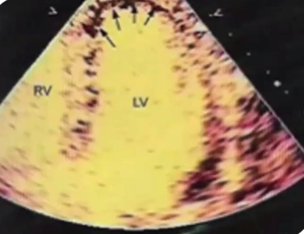 Perfusion - 左室室腔呈现黄色,左室室壁呈现橘红色的点状成像,在心尖箭头处可以看到呈现黑色的部分,这是没有充盈增强剂的表现,说明局部室壁有变薄,有疤痕形成,局部血供是降低的