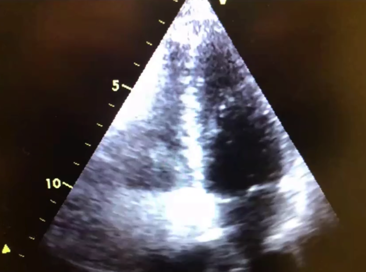 右心是高亮的,由于有微泡的充盈;左心室可以看到几个小气泡/白点。