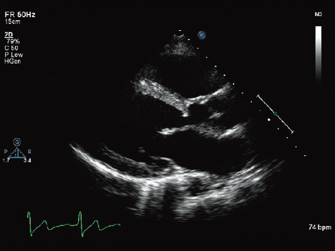 Subaortic stenosis. A fibromuscular ridge is seen proximal to the aortic valve (arrow).