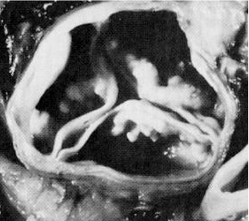 Normal geriatric calcific valve