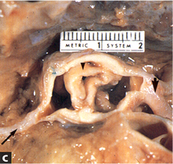 Rheumatic