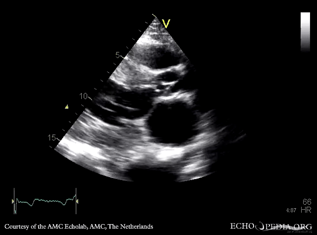 PLAX: subvalvular membrane in left ventricle outflow tract