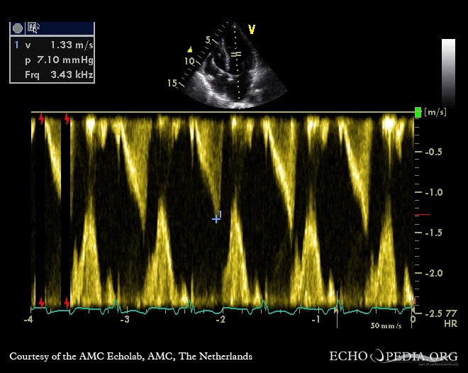 Continuous-wave doppler signal: dynamic gradient in the middle of left ventricle