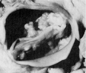 Bicuspid Ao V