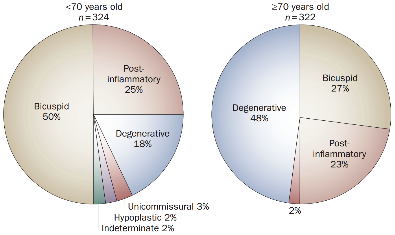 Etiology of aortic valve stenosis. Congenital bicuspid valve accounts for 50% of surgical cases in patients aged <70 years. (Passik CS, Ackermann DM, Pluth JR, Edwards WD. Temporal changes in the causes of aortic stenosis: a surgical pathologic study of 646 cases. Mayo Clin Proc 1987;62:119–123).