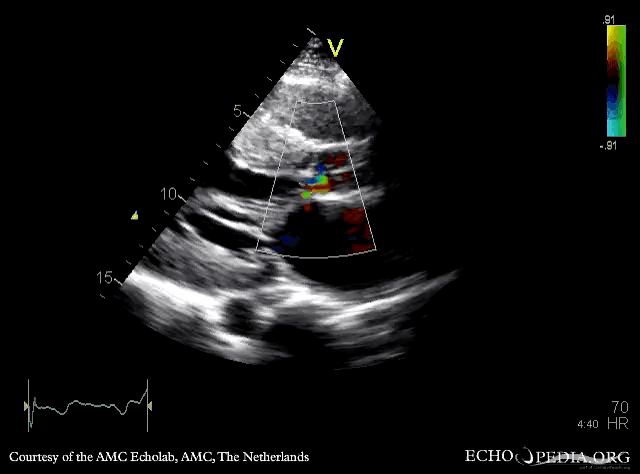 PLAX with Color Doppler: high velocity flow in left ventricle outflow tract