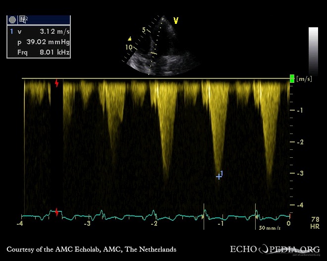 Continuous-wave doppler signal: dynamic gradient in LVOT