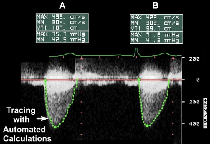 Calculation of trans-aortic gradients by continuous-wave Doppler. 通过连续波多普勒计算经主动脉瓣压差。