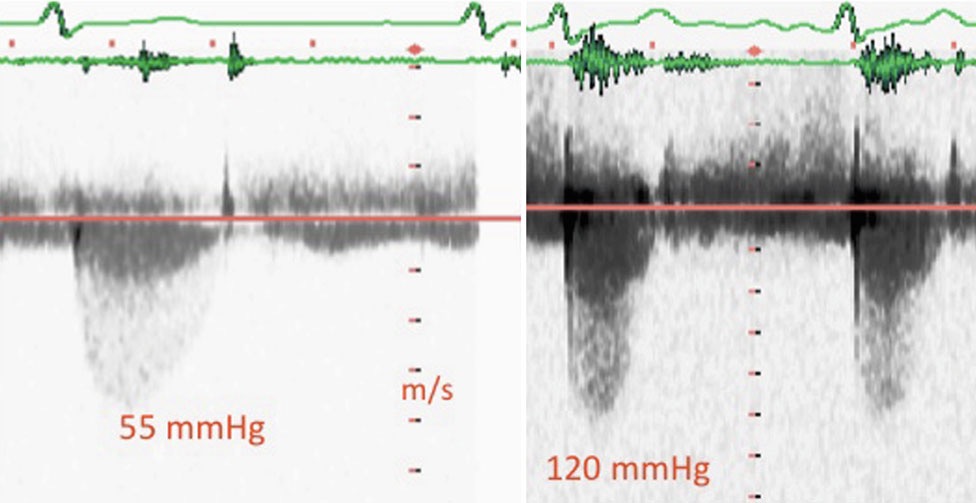 ( b ) CW Doppler from a patient with moderate aortic stenosis at rest ( left ) and peak stress ( right ) at the time of symptom development. Note the signifi cant rise in gradient 中度主动脉狭窄患者静息时(左)和峰值负荷时(右)进行的CW多普勒检测。请注意,压差不能显著上升