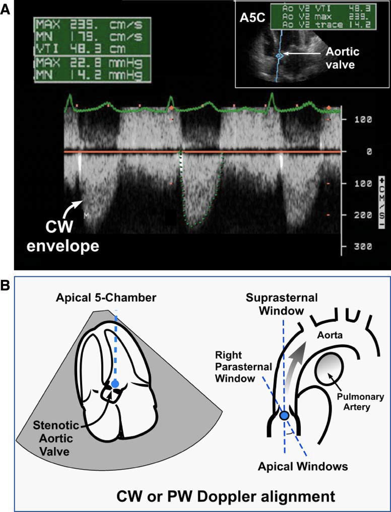 (A) Continuous-wave (CW) Doppler of maximum velocity across stenotic aortic valve. (B) Optimal Doppler alignment for assessment of peak velocities in aortic stenosis.(A)穿过狭窄主动脉瓣的最大速度的连续波(CW)多普勒。(B)用于评估主动脉狭窄峰值速度的最佳多普勒对齐。