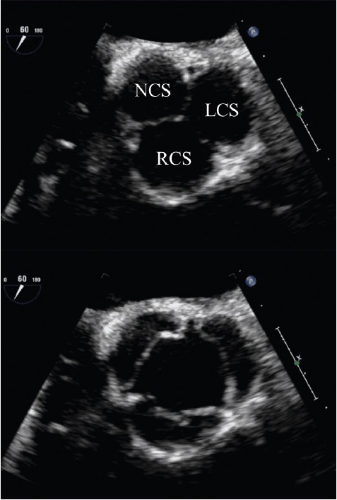 Mid-esophageal short-axis TEE views showing closure (upper panel) and opening (lower panel) of the aortic cusps. LCC, left coronary cusp; NCC, non coronary cusp; RCC, right coronary cusp