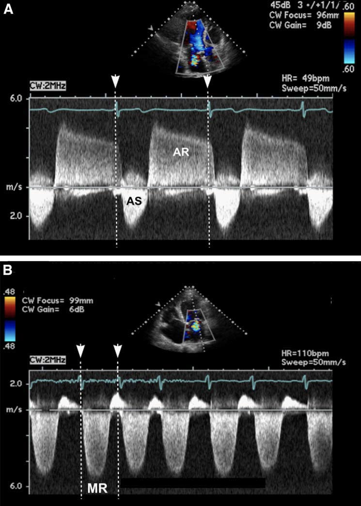 Distinguishing aortic stenosis from mitral regurgitation on Doppler examination. 在多普勒检查鉴别主动脉瓣狭窄和二尖瓣关闭不全。