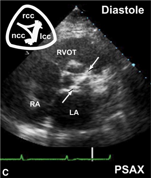 (A–C) Aortic stenosis showing thickened valve leaflets. 主动脉瓣狭窄表现为瓣叶增厚 (C) Commissural fusion (arrows) is a hallmark feature of rheumatic valvular heart disease. 交界融合(箭头)是风湿性心脏瓣膜病的一个特征。
