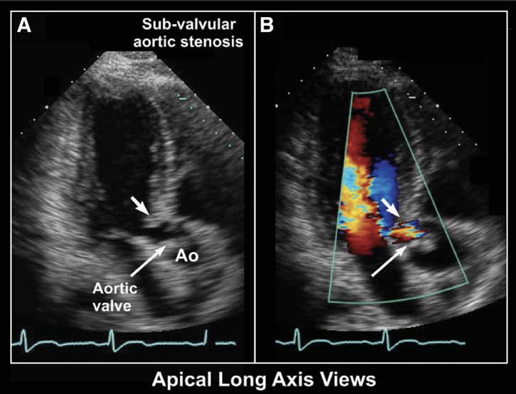 Subvalvular aortic stenosis (arrows) with fixed membrane seen in apical long-axis view (A).心尖长轴切面可见主动脉瓣下狭窄(箭头)伴膜性结构(A)。