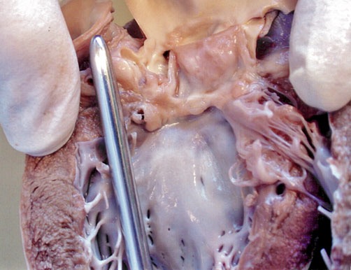 A section in the long axis of the left ventricle and outfl ow tract from a patient with subaortic stenosis. Note the fibrous ridge beneath the aortic cusps 主动脉瓣下狭窄患者左心室长轴和流出道的一段。注意主动脉瓣下的纤维嵴