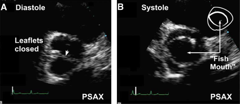 The appearance of the valve in systole is characteristic of this etiology, and has been referred to as a fish-mouth appearance, rather than the triangular appearance of normal valves 收缩期瓣膜的外观是这种病因的特征,被称为鱼嘴外观,而不是正常瓣膜的三角形外观