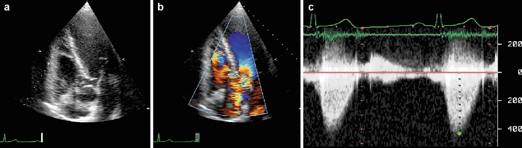 ( a ) Apical 5 chamber view from a young patient with subaortic stenosis. Note the location of the membrane in relation to the valve cusps. 主动脉瓣下狭窄年轻患者的心尖5腔视图。记录膜相对于瓣尖的位置。( b ) Color flow Doppler showing aliasing at the site of narrowing. 彩色多普勒显示狭窄部位的混叠( c ) Continuous wave Doppler from the same patient showing raised outfl ow tract pressure drop in the order of 70 mmHg and mild regurgitation 来自同一患者的连续波多普勒显示流出道压差升高约70 mmHg和轻度反流