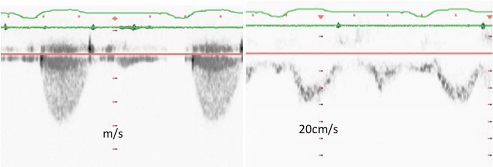 ( a ) Continuous wave Doppler ( left ) from the same patient and pulsed wave Doppler velocities of the subaortic area. 来自同一患者的连续波多普勒(左)和主动脉下区的脉冲波多普勒速度。 Note the >5 times increase in velocities between the two areas consistent with severe aortic stenosis. 注意,两个区域之间的速度增加 > 5倍,提示严重主动脉瓣狭窄