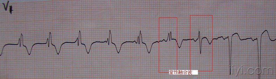 一个典型的心室夺获与室性融合波图例