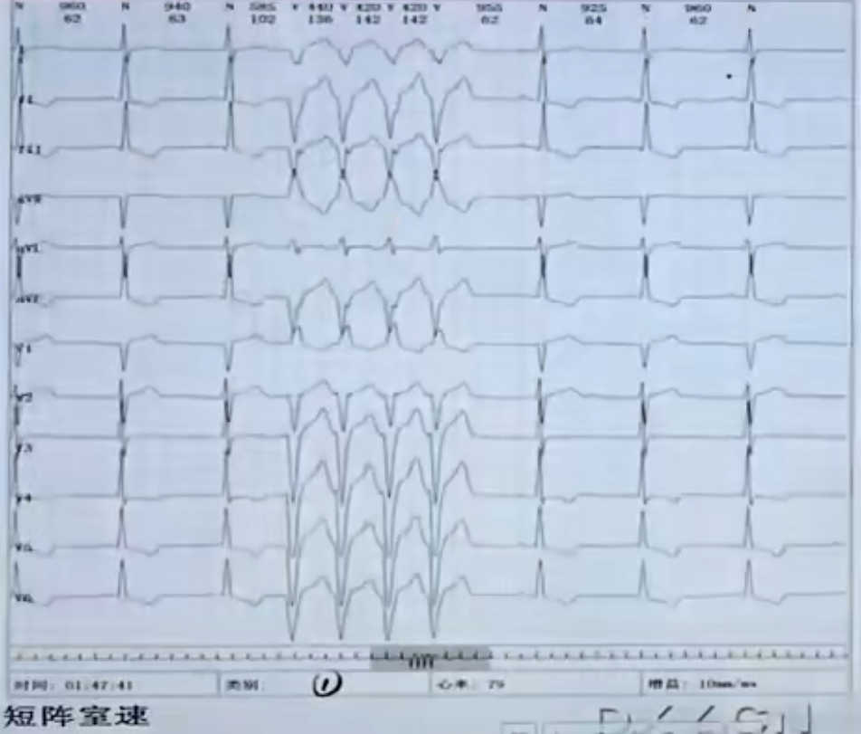 一个短阵室速图例