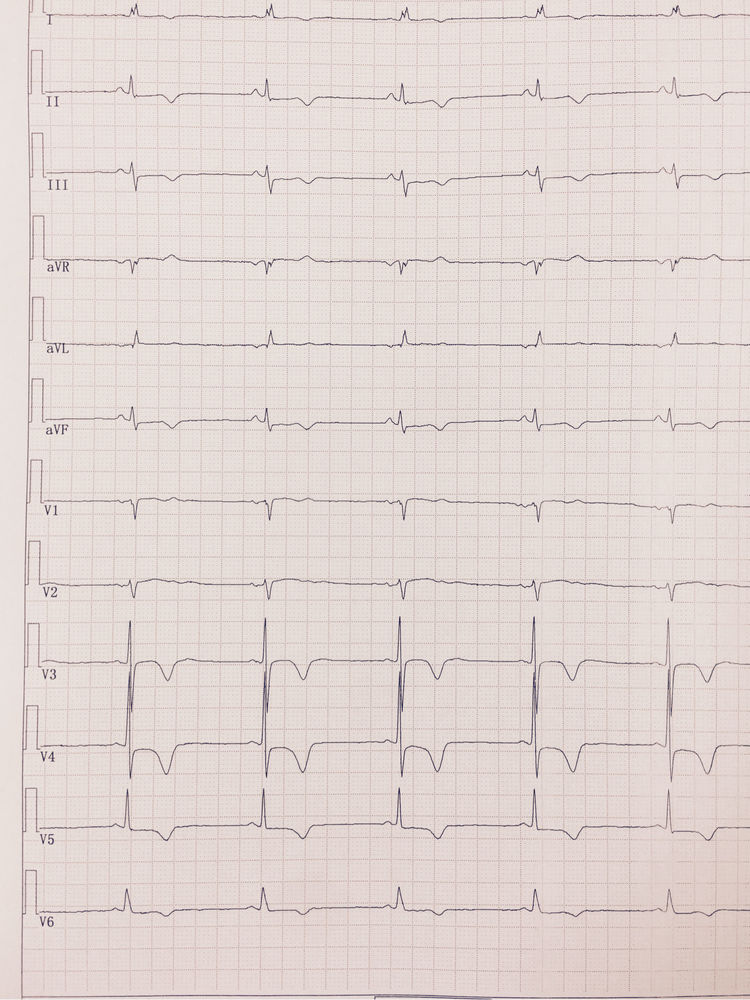 一张典型的窦性心动过缓图例