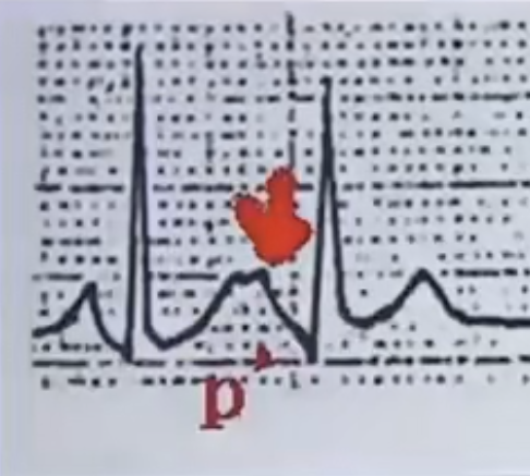 一个典型 T-P 融合的房早图例