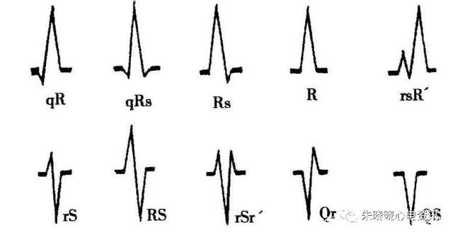 各种QRS波图例