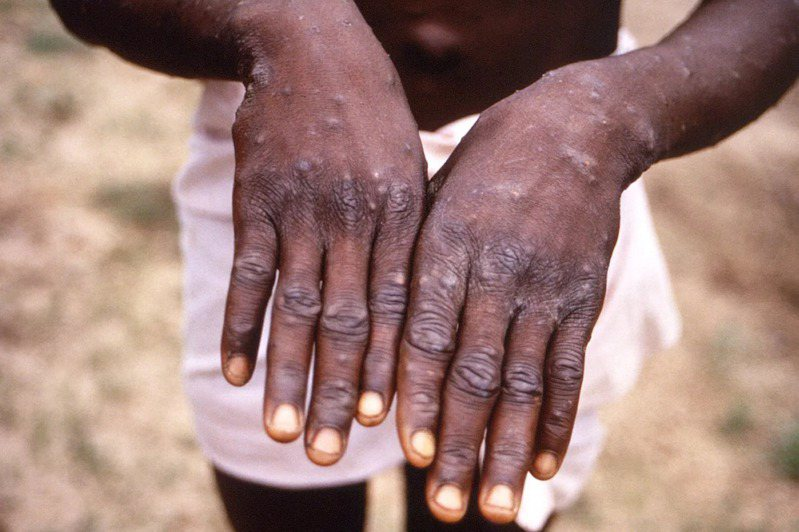 How to Properly Prevent Smallpox(Monkeypox)?
