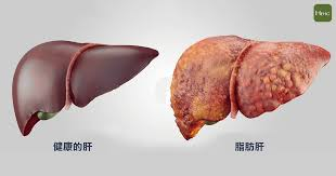 4 Ways to Get Rid of a Fatty Liver