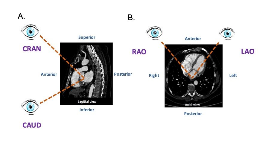 FIGURE 4 - Attitudinal viewing of MSCT image simulating the C-arm rotation around a lying patient in the catheterization laboratory. (A) Sagittal view: from an anterior position structure closer to the head are labelled as cranial (CRA) and those closer to the feet are labelled as caudal (CAU). (B) Axial view: from an anterior position structure closer to the right of the patients are labelled as right anterior oblique (RAO) and those closer to the left are labelled as left anterior oblique (LAO). FIGURE 4