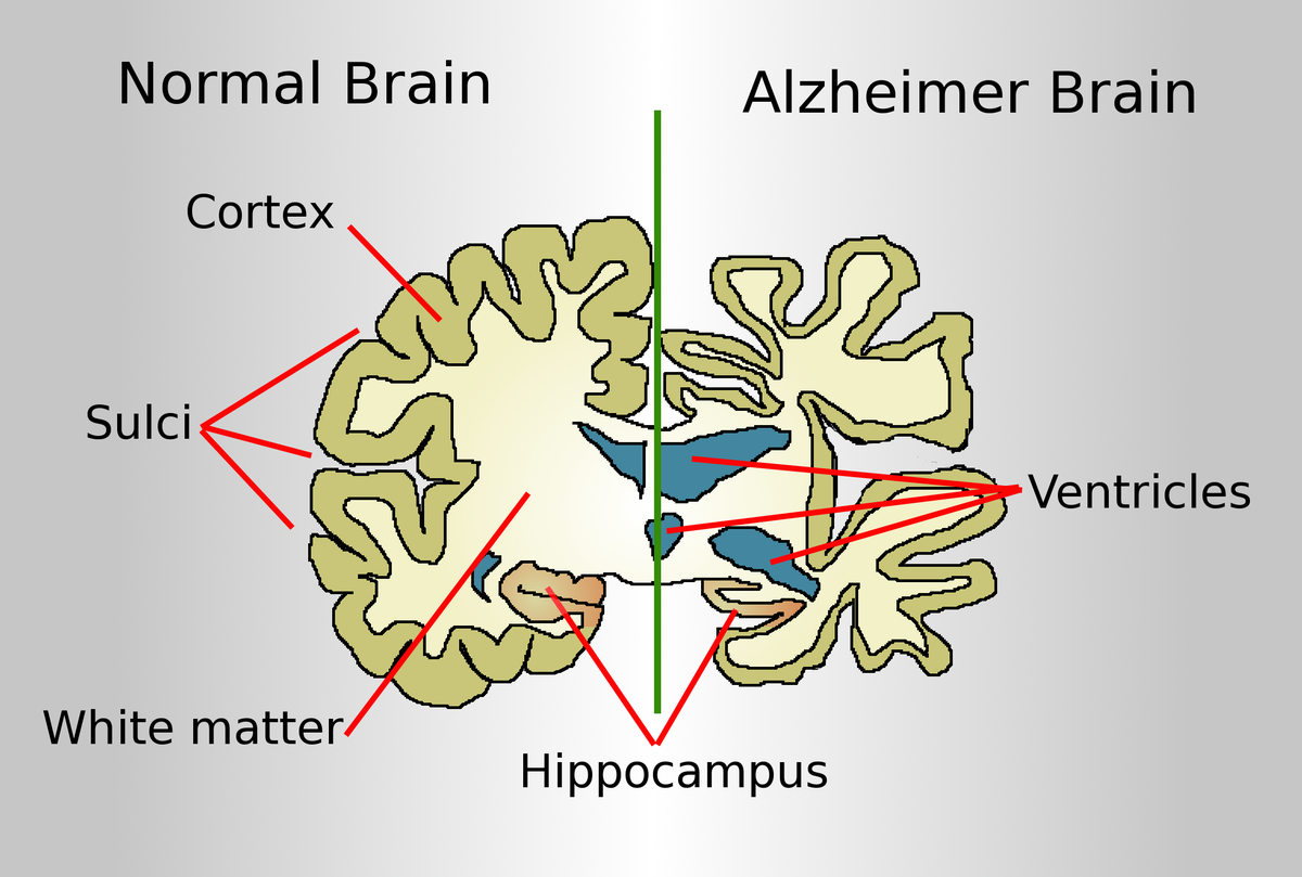 How can I prevent Alzheimer's?